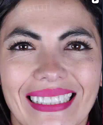Paciente Javiera - Diseño de sonrisa