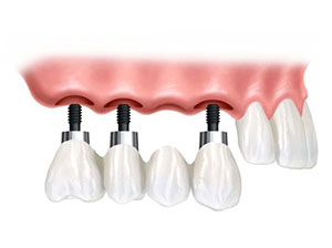 implantes dentales, implante dental de puente