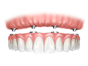 implantes dentales, implante dental total