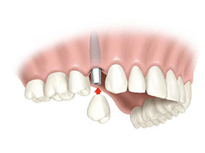 implantes dentales, implante dental unitario