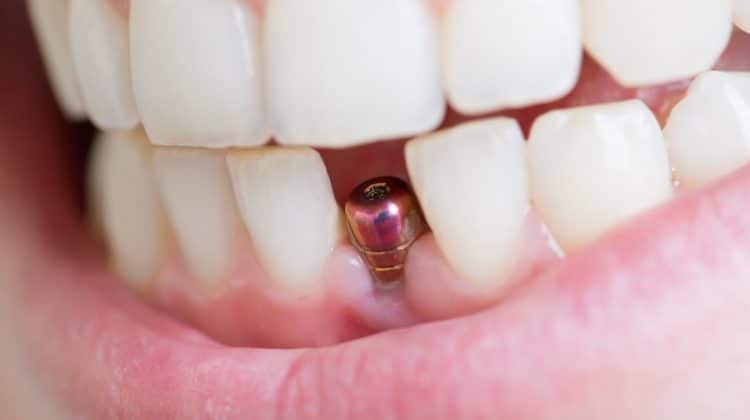¿Cuánto tiempo tarda en sanar un implante dental?