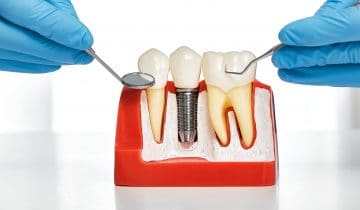 Las 7 dudas más frecuentes sobre implantes dentales
