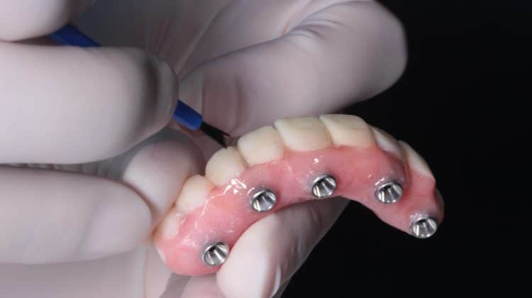 Prótesis dentales ¿Fijas o removibles?
